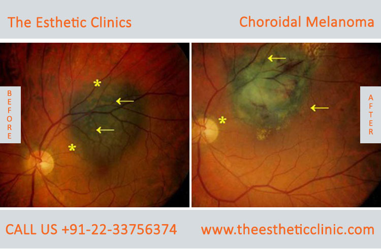 Choroidal Melanoma Eye Cancer Treatment before after photos in mumbai india (1)